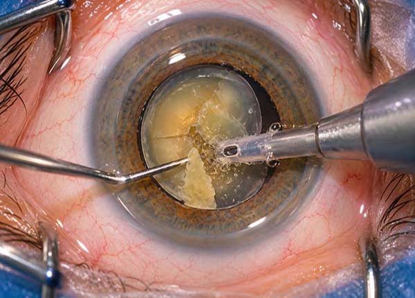 Facoemulsificación