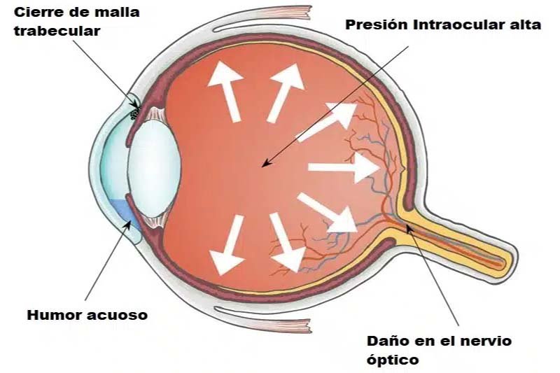 Glaucoma