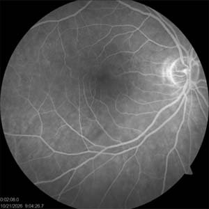 Examen de retina